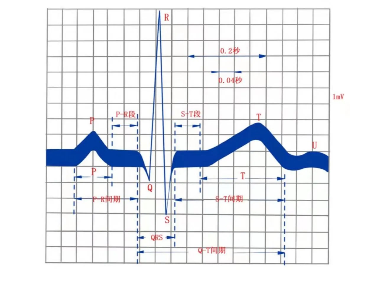 心电图怎么看图解