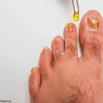 脚指甲变黄变厚是怎么回事