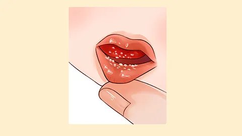 口角生疮怎么办