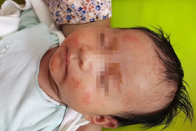 新生儿湿疹和痱子的区别图片