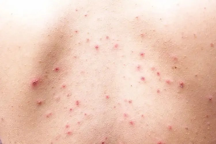 身上长包包的症状图片