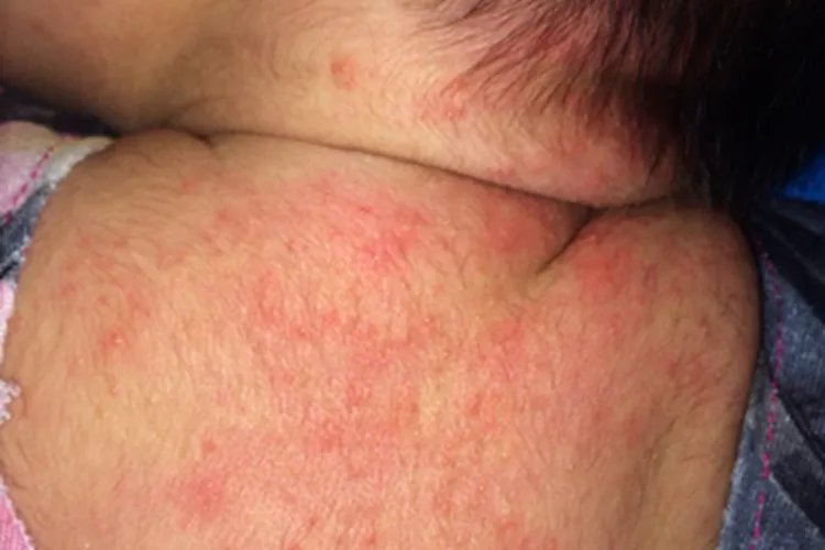 新生儿湿疹和痱子的区别图片