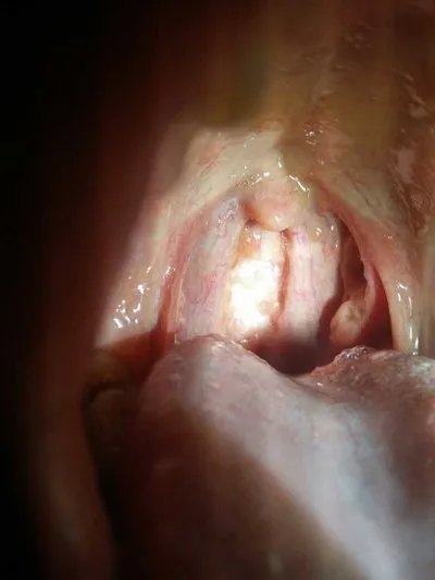 治疗咳嗽的最快方法有哪些？