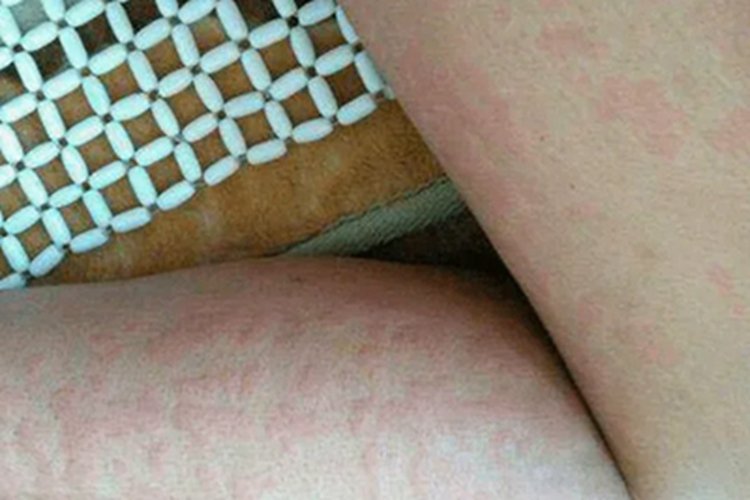 血吸虫病症状图片