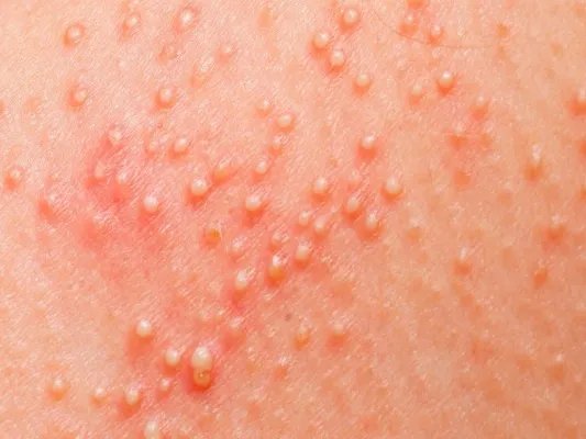 去痘疤最有效的方法