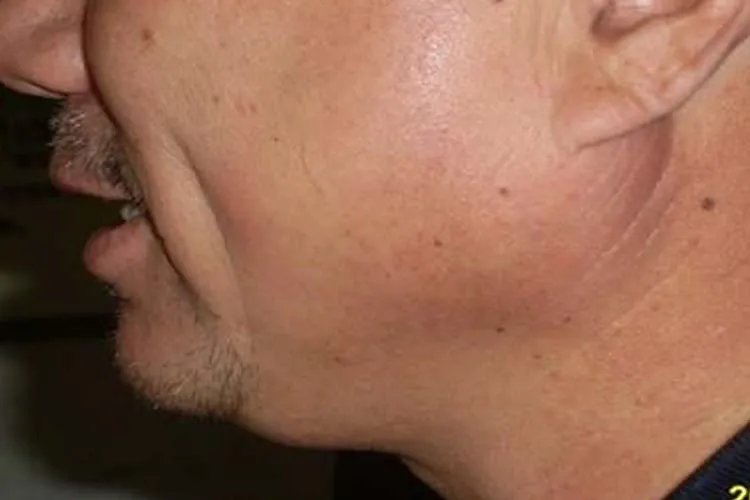 腮腺炎的症状图片