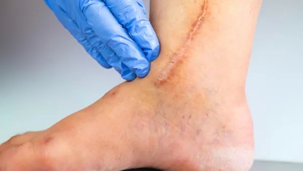 怎么去除手术疤痕