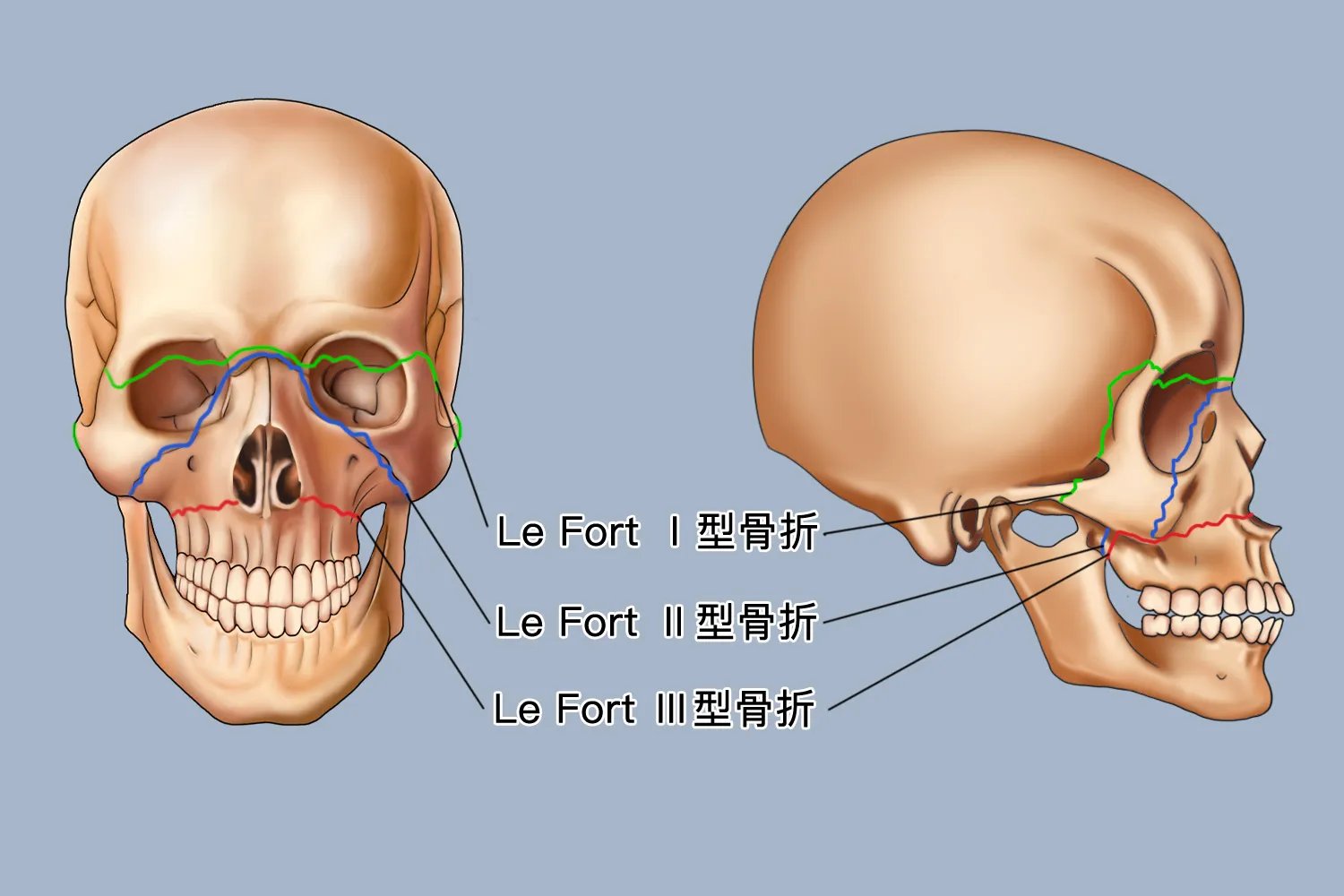 Le Fort三种骨折图解