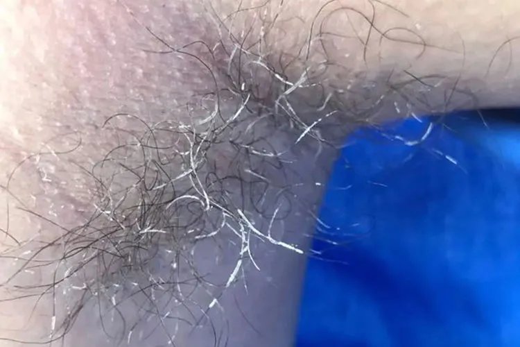 腋毛癣症状图片