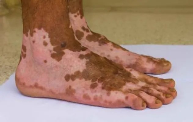 黑人得白癜风不就很白了吗