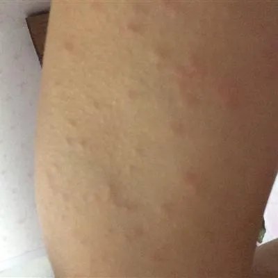 疥疮有什么症状?