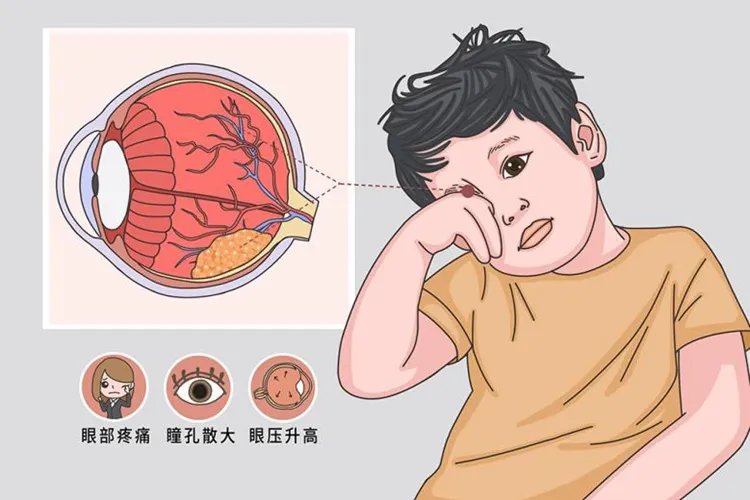 视网膜母细胞瘤图片