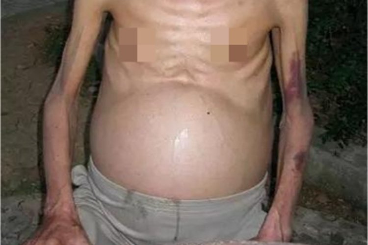 血吸虫病症状图片