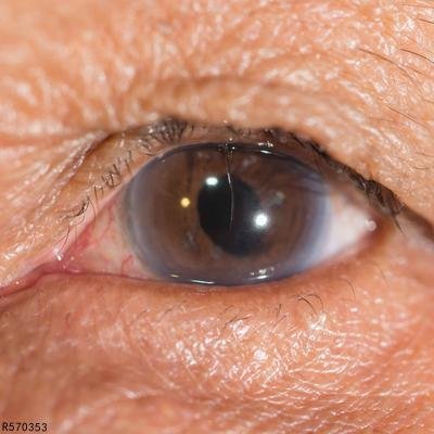 上眼皮黑是怎么回事