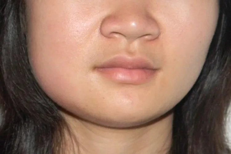 腮腺炎的症状图片