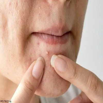 下巴上长痘痘是什么原因造成的