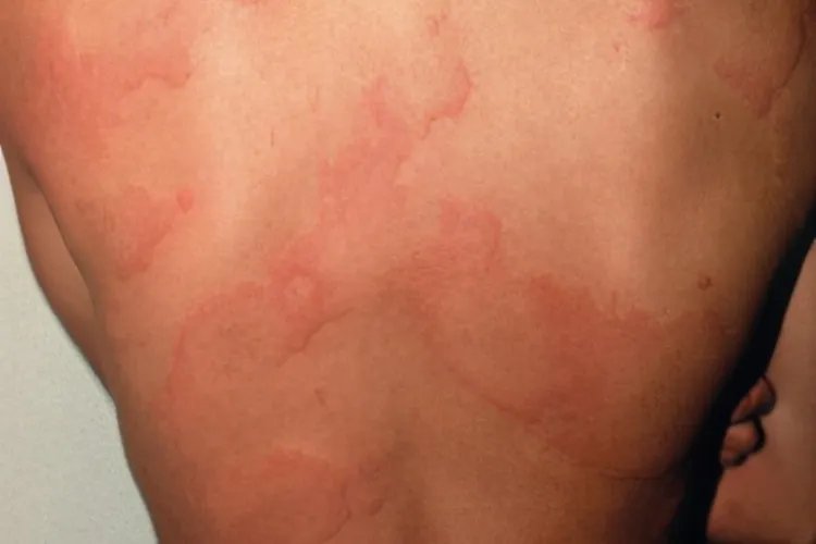 荨麻疹性血管炎早期图片