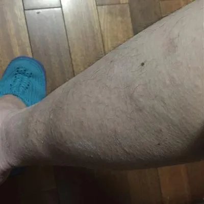 疥疮有什么症状?