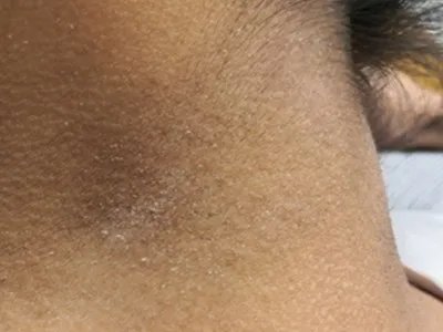 面颈部毛囊性红斑黑变病侧颈皮肤发黑图片