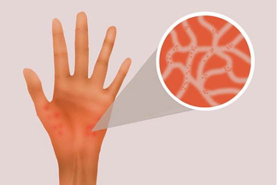 荨麻疹会传染吗