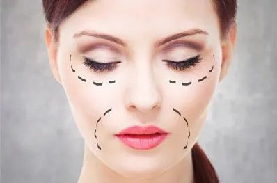 玻尿酸填充法令纹可以吗