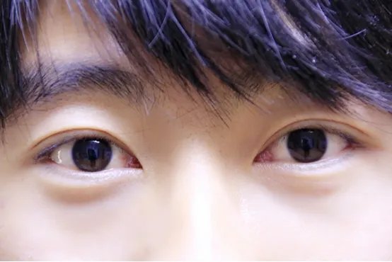 眼袋重是什么原因造成的