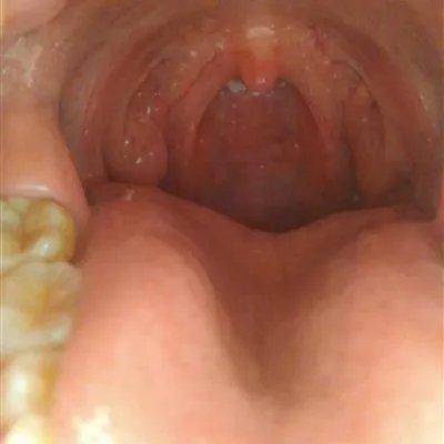 舌根有疙瘩是怎么回事?