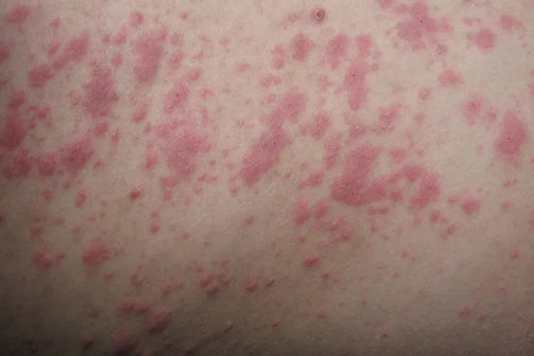 儿童螨虫过敏症状图片