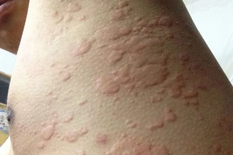 身上长包包的症状图片