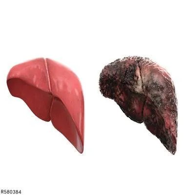 血吸虫肝硬化怎么防治