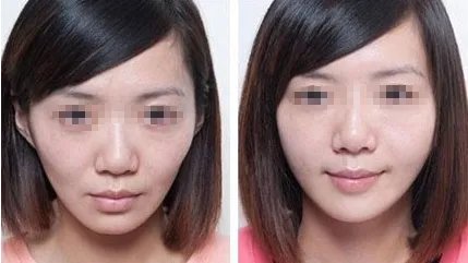 苏州做面部脂肪填充哪家医院好？