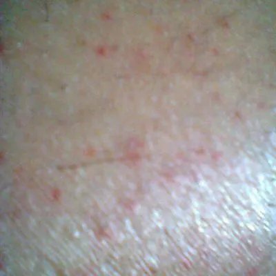 什么原因得紫癜