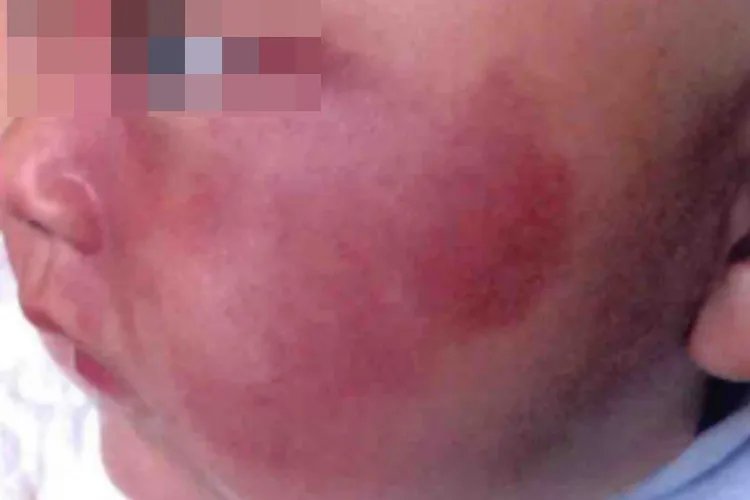 胎记有几种颜色的图片