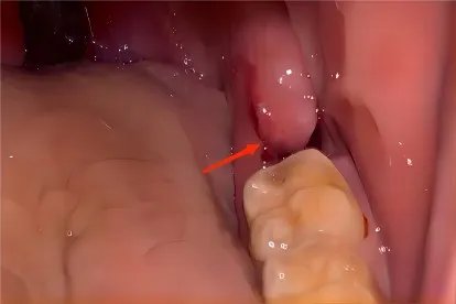 智齿拔牙后窟窿恢复图片