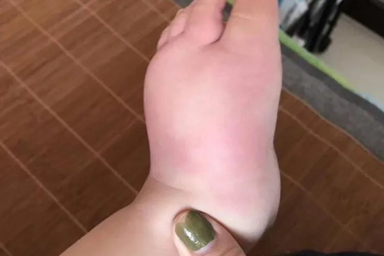 急性蜂窝组织炎的症状图片