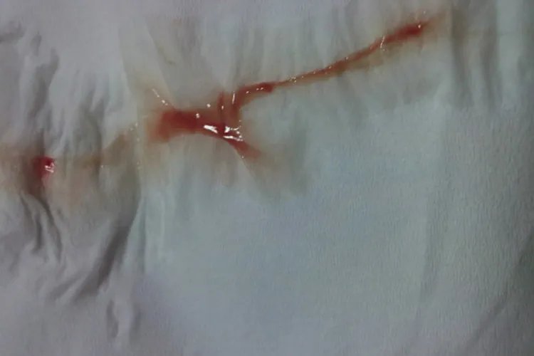 宫颈癌出血跟月经区别图片