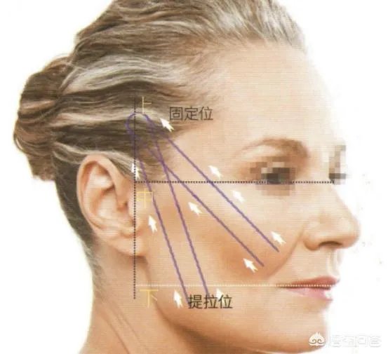 面部提升埋线是怎么回事？