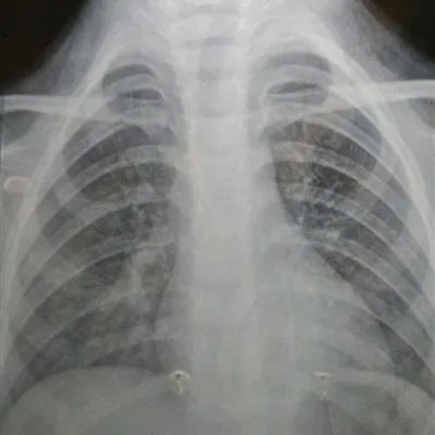 咳嗽破音是怎么回事?