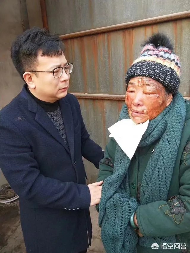 保定一老人卖房救助流浪狗，救助站不慎失火，为抢救狗狗烧伤半边脸，这个事你怎么看？