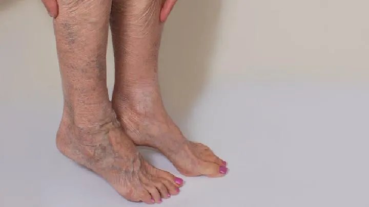 七叶皂苷素用于治疗精索静脉曲张