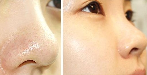 做光子嫩肤的注意事项