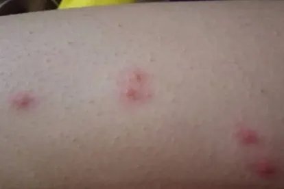 夏天身上长红疙瘩很痒图片