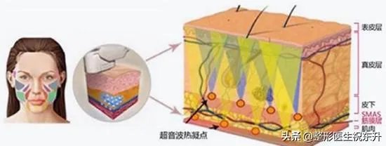 超声刀危害有哪些？