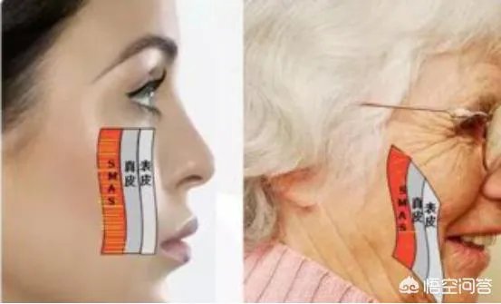 面部提升埋线是怎么回事？