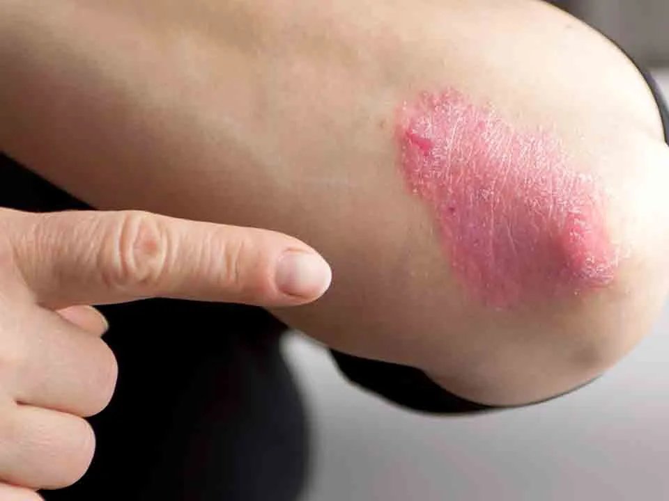 牛皮癣的初期图片现在的症状