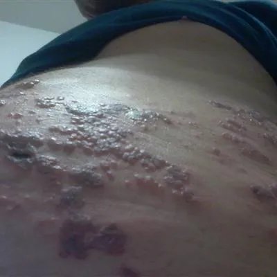 缠身龙是什么症状图片