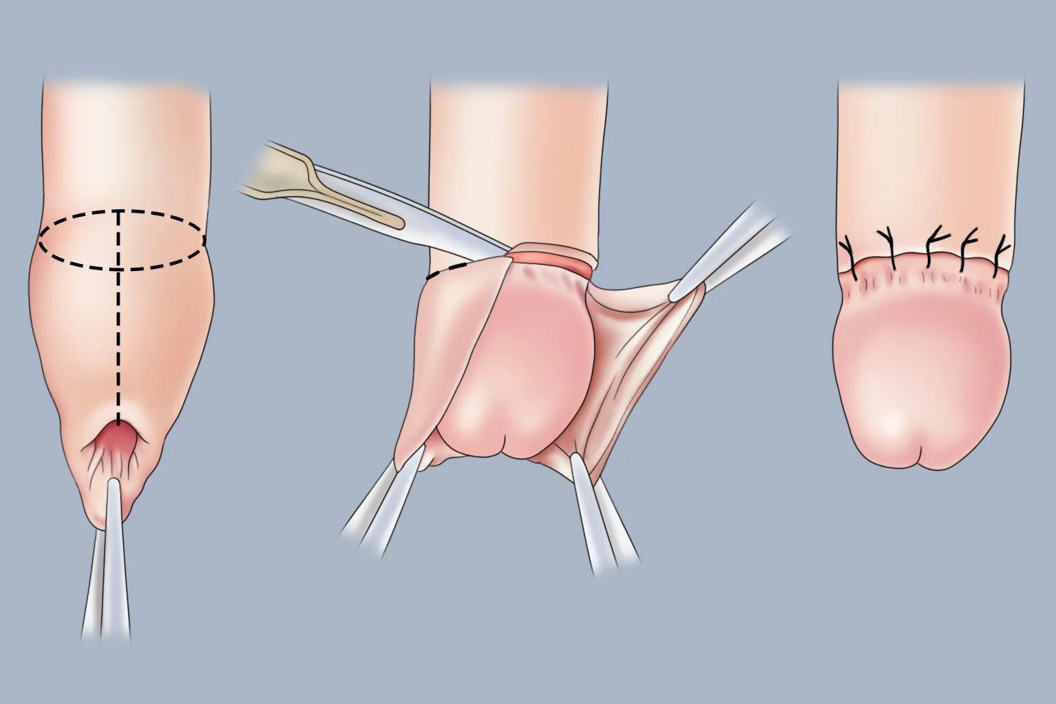 大人割包皮手术图片