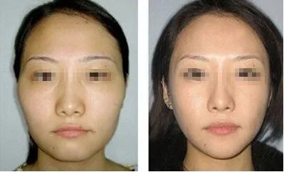 苏州做面部脂肪填充哪家医院好？