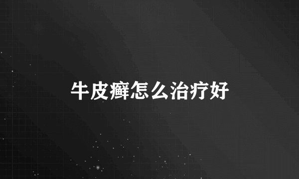 牛皮癣怎么治疗好