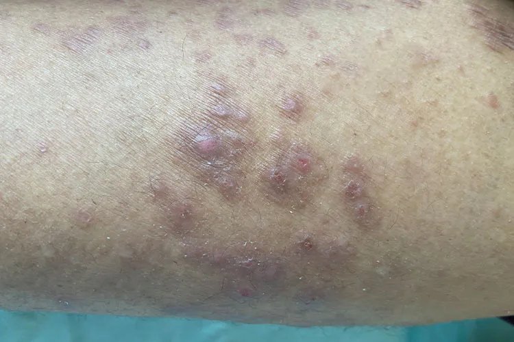 神经性皮炎图片